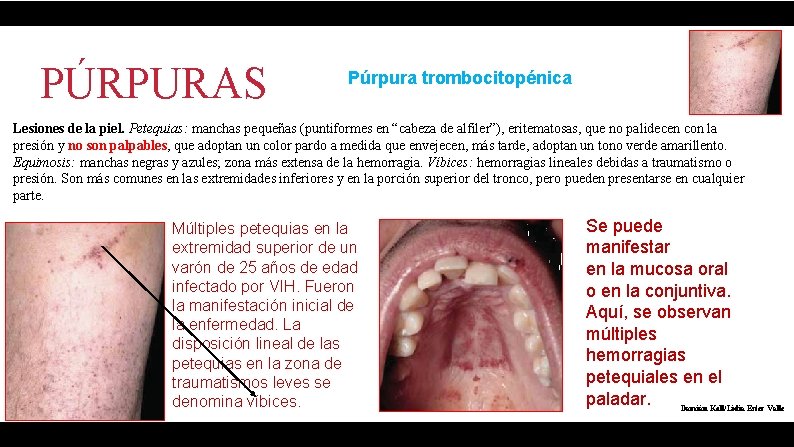 PÚRPURAS Púrpura trombocitopénica Lesiones de la piel. Petequias: manchas pequeñas (puntiformes en “cabeza de