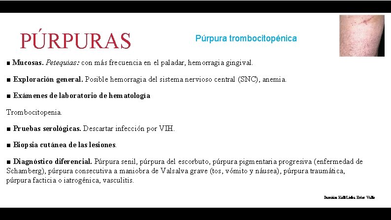 PÚRPURAS Púrpura trombocitopénica ■ Mucosas. Petequias: con más frecuencia en el paladar, hemorragia gingival.