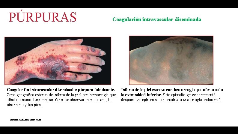 PÚRPURAS Coagulación intravascular diseminada: púrpura fulminante. Zona geográfica extensa de infarto de la piel