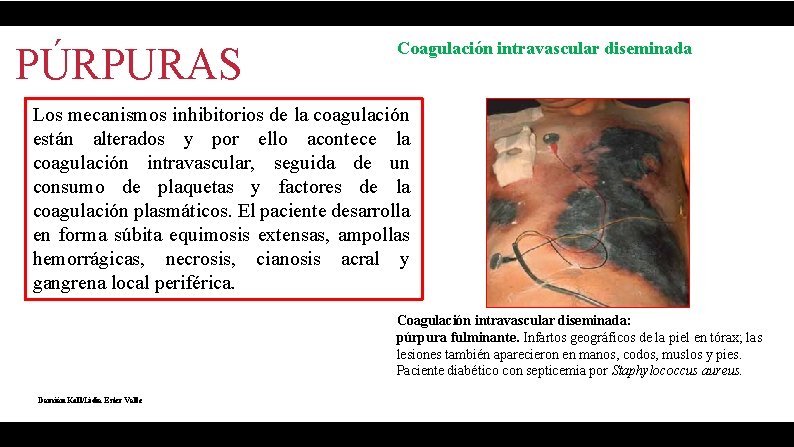 PÚRPURAS Coagulación intravascular diseminada Los mecanismos inhibitorios de la coagulación están alterados y por