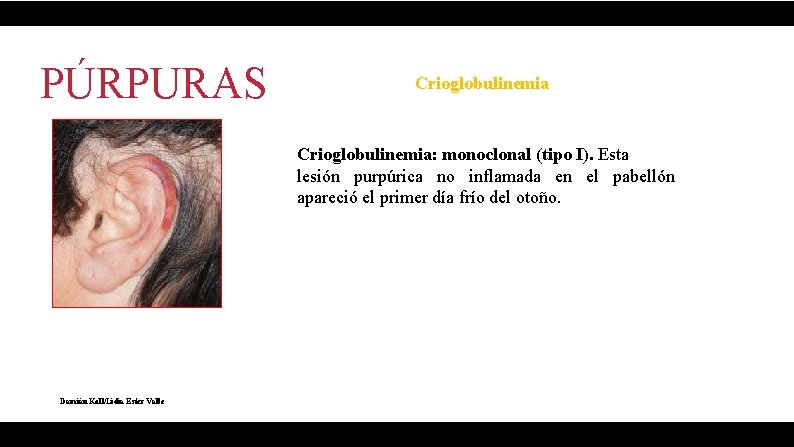 PÚRPURAS Crioglobulinemia: monoclonal (tipo I). Esta lesión purpúrica no inflamada en el pabellón apareció