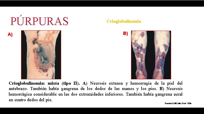 PÚRPURAS A) Crioglobulinemia B) Crioglobulinemia: mixta (tipo II). A) Necrosis extensa y hemorragia de