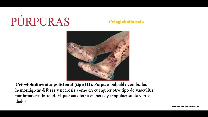 PÚRPURAS Crioglobulinemia: policlonal (tipo III). Púrpura palpable con bullas hemorrágicas difusas y necrosis como