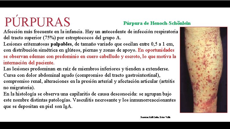 PÚRPURAS Púrpura de Henoch-Schönlein Afección más frecuente en la infancia. Hay un antecedente de