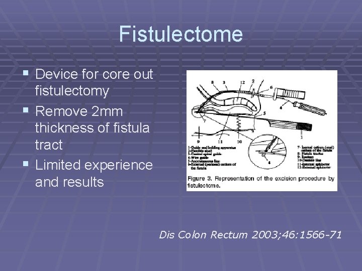 Fistulectome § Device for core out fistulectomy § Remove 2 mm thickness of fistula