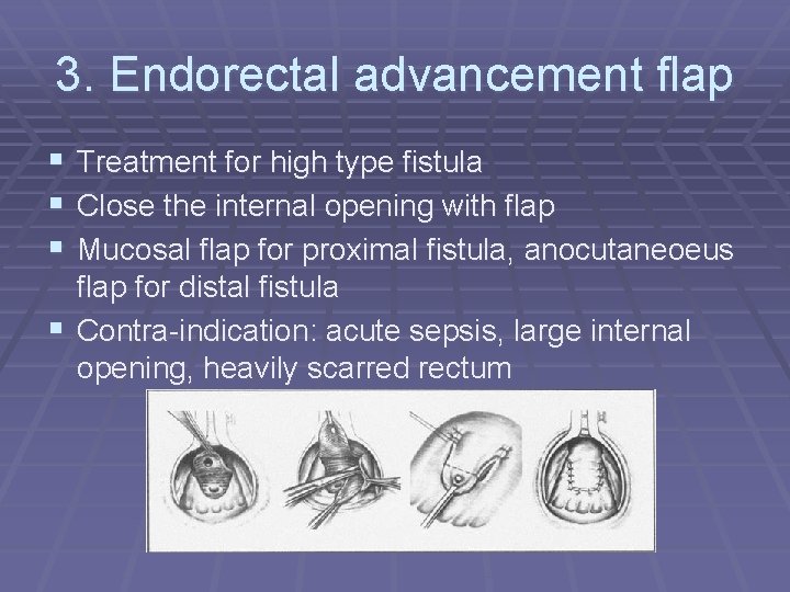 3. Endorectal advancement flap § Treatment for high type fistula § Close the internal