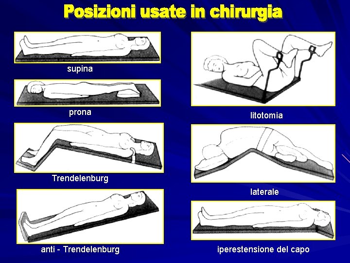 supina prona litotomia Trendelenburg laterale anti - Trendelenburg iperestensione del capo 