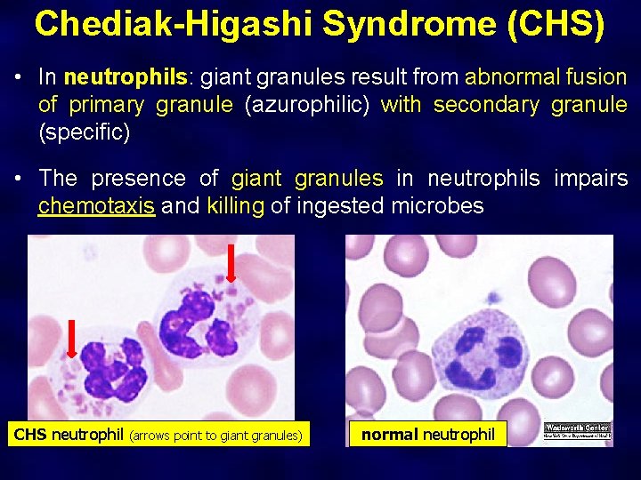 Chediak-Higashi Syndrome (CHS) • In neutrophils: giant granules result from abnormal fusion of primary