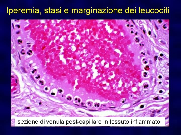 Iperemia, stasi e marginazione dei leucociti sezione di venula post-capillare in tessuto infiammato 