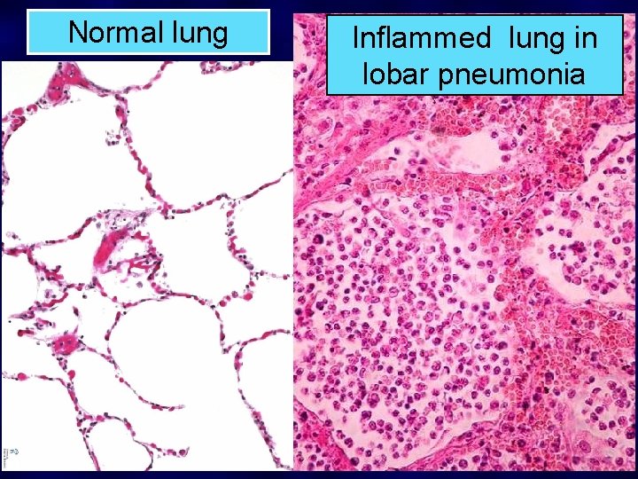 Normal lung Inflammed lung in lobar pneumonia 