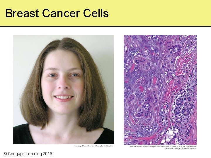 Breast Cancer Cells © Cengage Learning 2016 