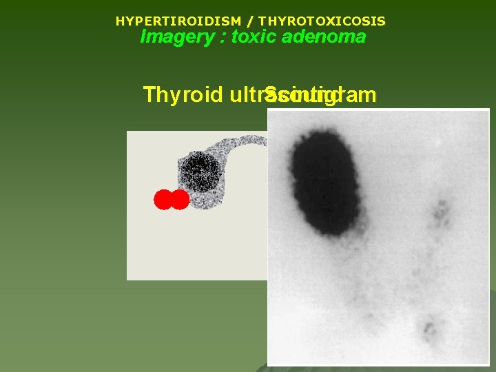 HYPERTIROIDISM / THYROTOXICOSIS Imagery : toxic adenoma Thyroid ultrasound Scintigram HYPERTIROIDISM / THYROTOXICOSIS Imagery : toxic adenoma Thyroid ultrasound Scintigram