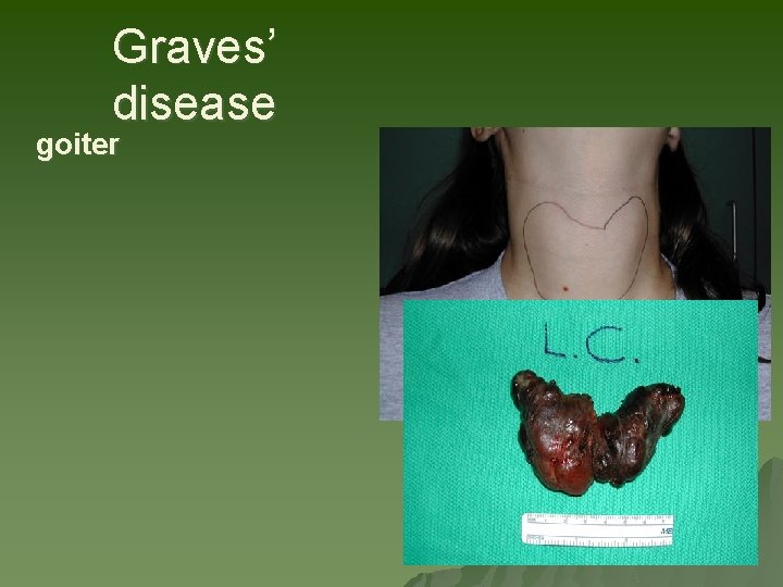 Graves’ disease goiter Graves’ disease goiter