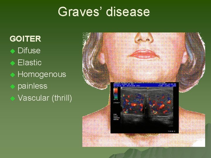 Graves’ disease GOITER u Difuse u Elastic u Homogenous u painless u Vascular (thrill) Graves’ disease GOITER u Difuse u Elastic u Homogenous u painless u Vascular (thrill)