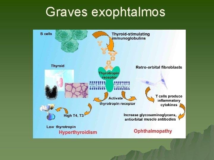 Graves exophtalmos Graves exophtalmos