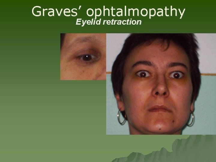 Graves’ ophtalmopathy Eyelid retraction Graves’ ophtalmopathy Eyelid retraction