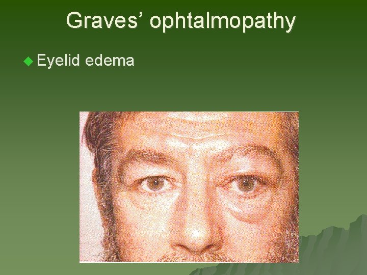 Graves’ ophtalmopathy u Eyelid edema Graves’ ophtalmopathy u Eyelid edema