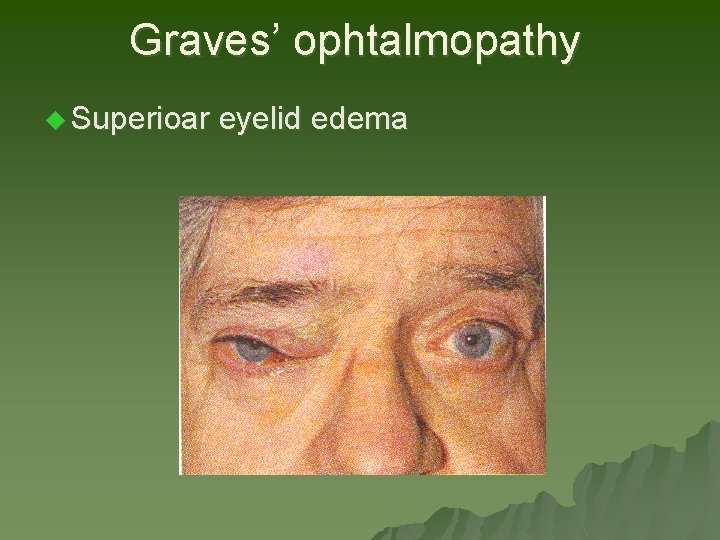 Graves’ ophtalmopathy u Superioar eyelid edema Graves’ ophtalmopathy u Superioar eyelid edema