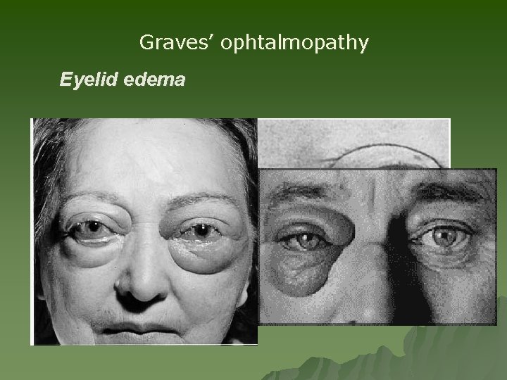 Graves’ ophtalmopathy Eyelid edema Graves’ ophtalmopathy Eyelid edema