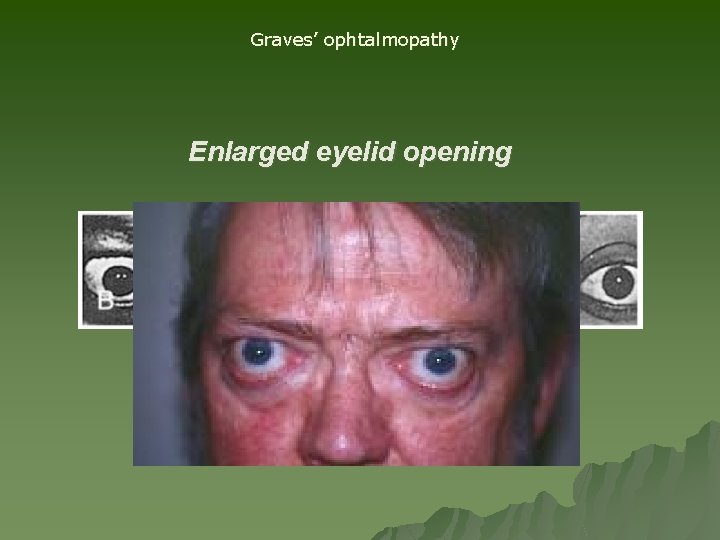 Graves’ ophtalmopathy Enlarged eyelid opening Graves’ ophtalmopathy Enlarged eyelid opening