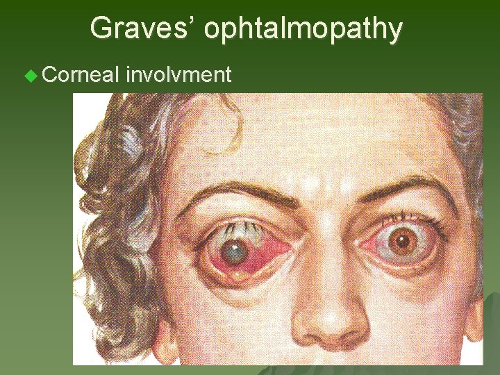 Graves’ ophtalmopathy u Corneal involvment Graves’ ophtalmopathy u Corneal involvment