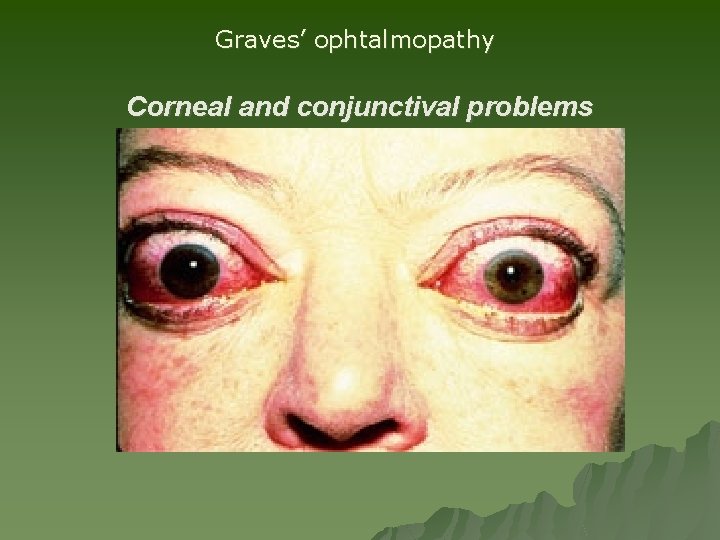 Graves’ ophtalmopathy Corneal and conjunctival problems Graves’ ophtalmopathy Corneal and conjunctival problems