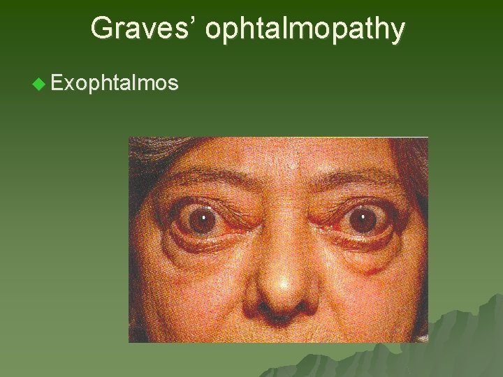 Graves’ ophtalmopathy u Exophtalmos Graves’ ophtalmopathy u Exophtalmos