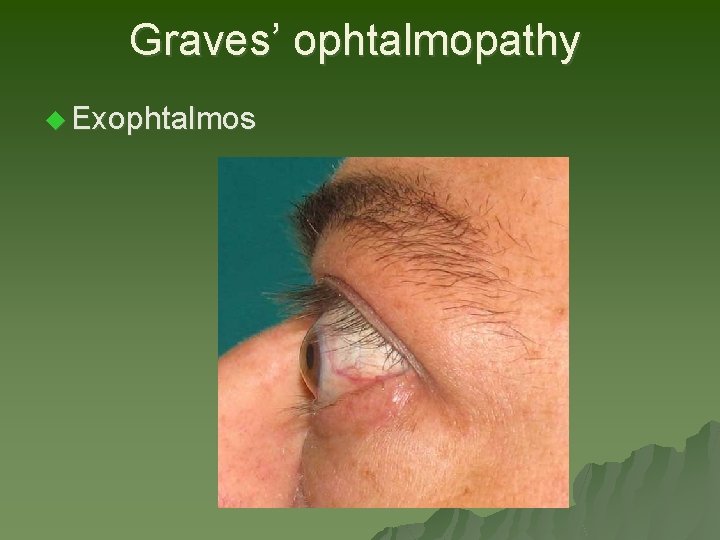 Graves’ ophtalmopathy u Exophtalmos Graves’ ophtalmopathy u Exophtalmos