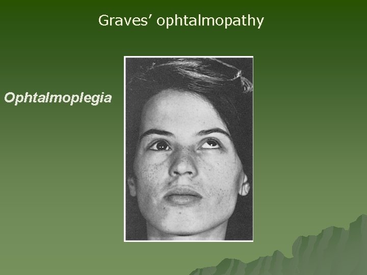 Graves’ ophtalmopathy Ophtalmoplegia Graves’ ophtalmopathy Ophtalmoplegia