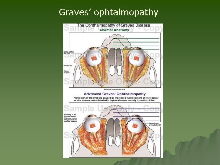Graves’ ophtalmopathy Graves’ ophtalmopathy