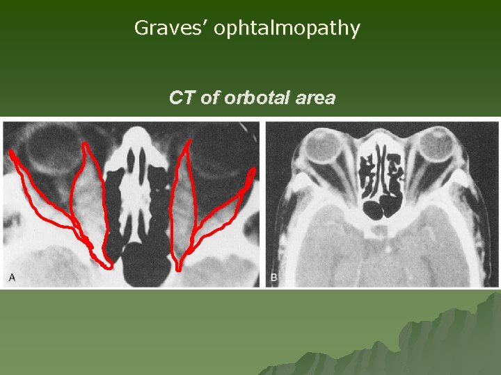 Graves’ ophtalmopathy CT of orbotal area Graves’ ophtalmopathy CT of orbotal area