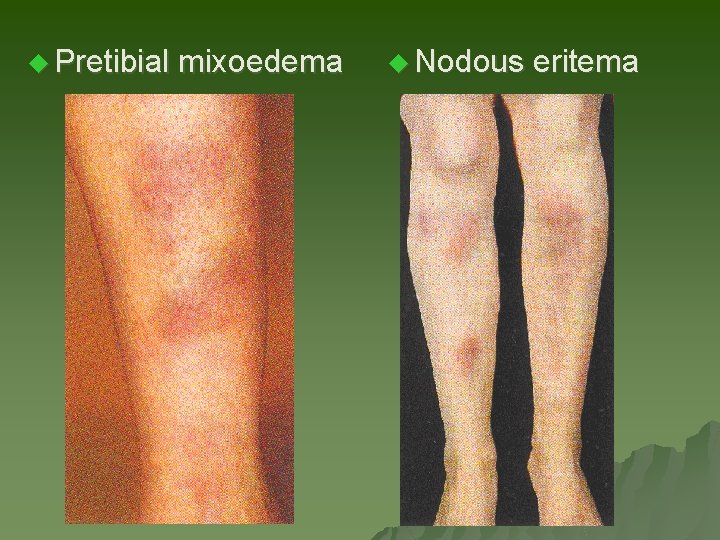 u Pretibial mixoedema u Nodous eritema u Pretibial mixoedema u Nodous eritema