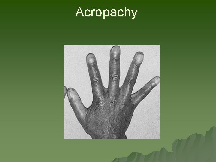 Acropachy Acropachy