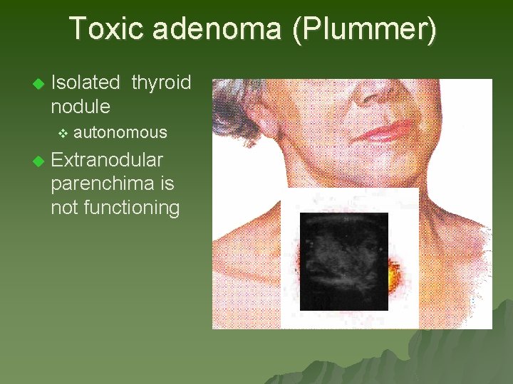 Toxic adenoma (Plummer) u Isolated thyroid nodule v autonomous u Extranodular parenchima is not Toxic adenoma (Plummer) u Isolated thyroid nodule v autonomous u Extranodular parenchima is not