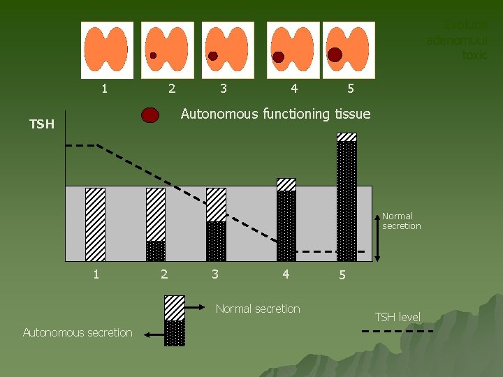 Evolutia adenomuui toxic 1 2 3 4 5 Autonomous functioning tissue TSH Normal secretion Evolutia adenomuui toxic 1 2 3 4 5 Autonomous functioning tissue TSH Normal secretion