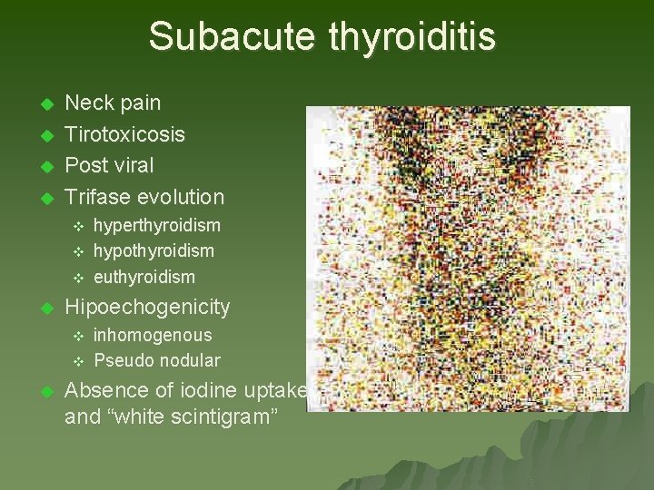 Subacute thyroiditis u u Neck pain Tirotoxicosis Post viral Trifase evolution v v v Subacute thyroiditis u u Neck pain Tirotoxicosis Post viral Trifase evolution v v v