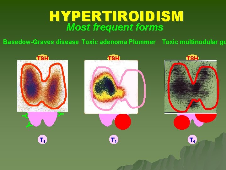 HYPERTIROIDISM Most frequent forms Basedow-Graves disease Toxic adenoma Plummer Toxic multinodular go TSH TSH HYPERTIROIDISM Most frequent forms Basedow-Graves disease Toxic adenoma Plummer Toxic multinodular go TSH TSH