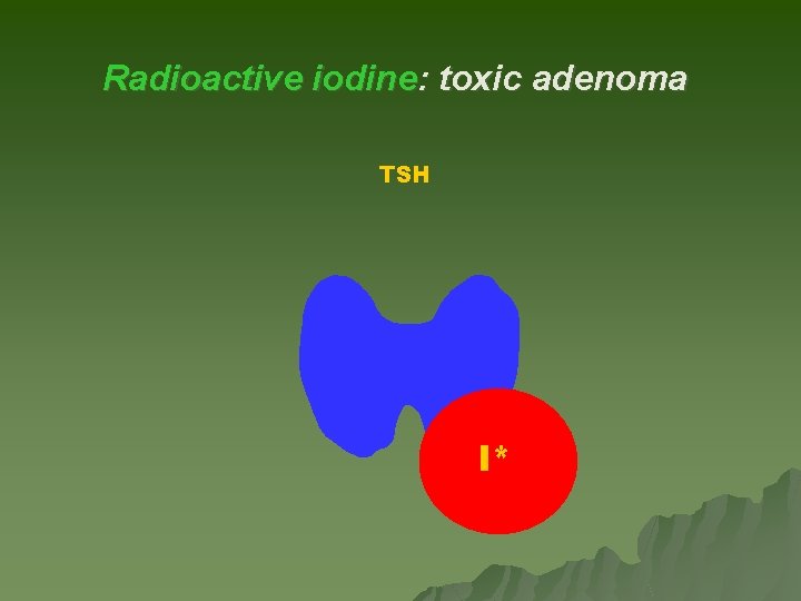 Radioactive iodine: toxic adenoma TSH I* T 4 Radioactive iodine: toxic adenoma TSH I* T 4