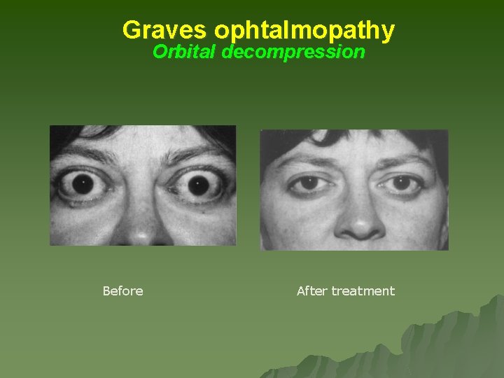 Graves ophtalmopathy Orbital decompression Before After treatment Graves ophtalmopathy Orbital decompression Before After treatment