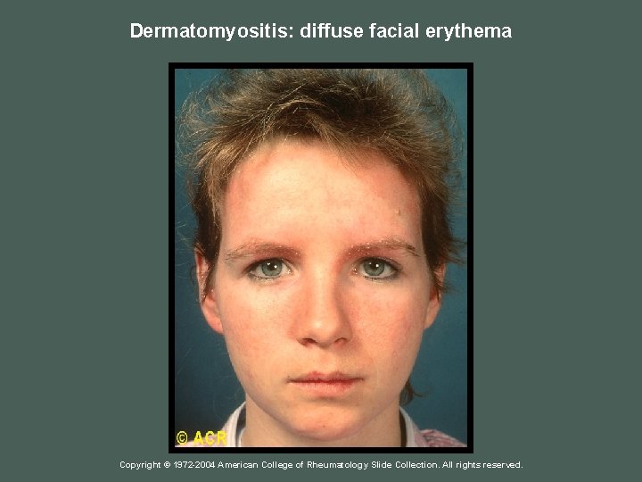 Dermatomyositis: diffuse facial erythema Copyright © 1972 -2004 American College of Rheumatology Slide Collection.