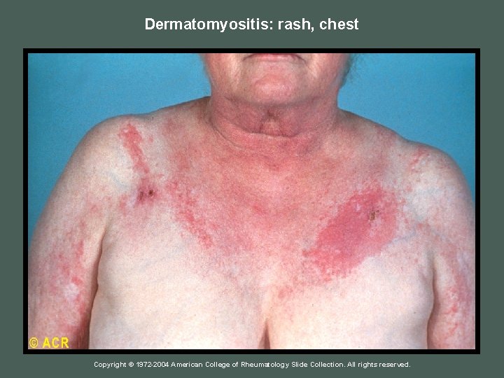 Dermatomyositis: rash, chest Copyright © 1972 -2004 American College of Rheumatology Slide Collection. All