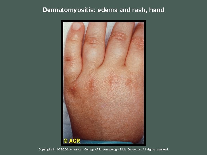 Dermatomyositis: edema and rash, hand Copyright © 1972 -2004 American College of Rheumatology Slide