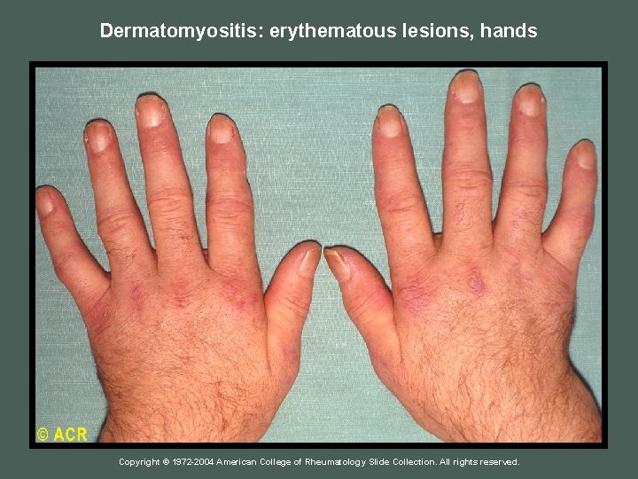 Dermatomyositis: erythematous lesions, hands Copyright © 1972 -2004 American College of Rheumatology Slide Collection.