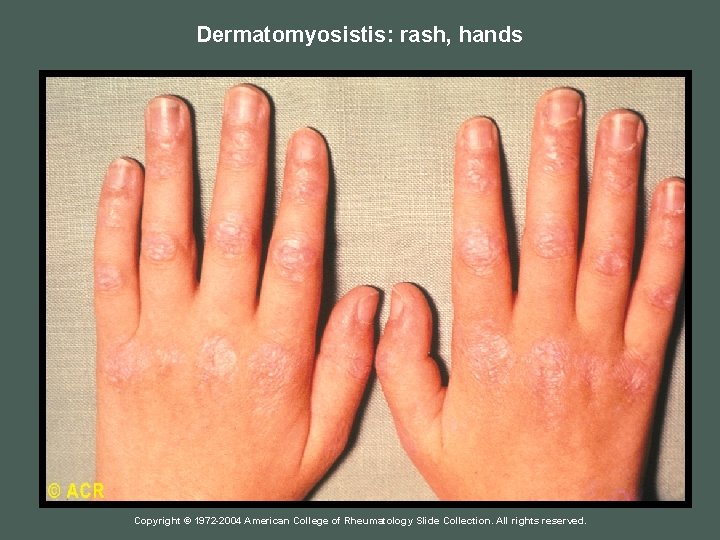 Dermatomyosistis: rash, hands Copyright © 1972 -2004 American College of Rheumatology Slide Collection. All