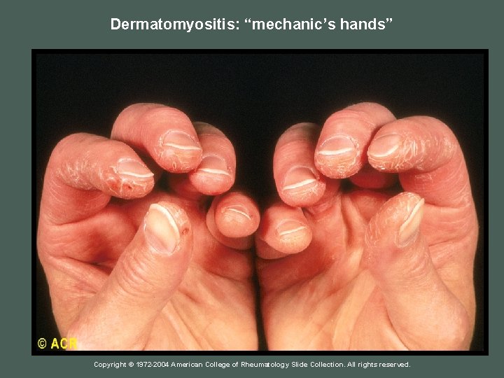 Dermatomyositis: “mechanic’s hands” Copyright © 1972 -2004 American College of Rheumatology Slide Collection. All