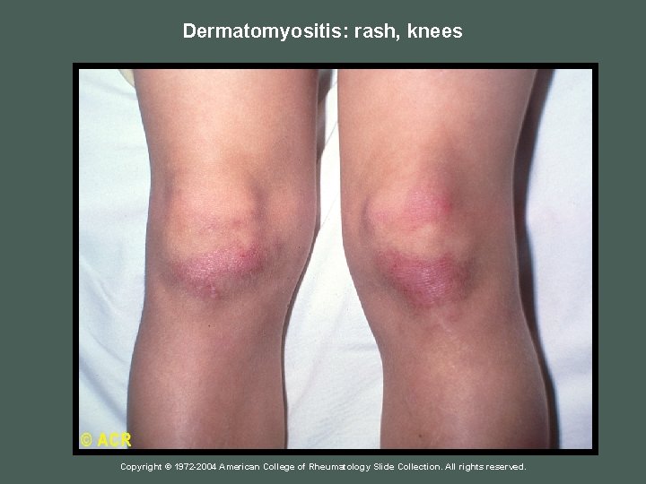 Dermatomyositis: rash, knees Copyright © 1972 -2004 American College of Rheumatology Slide Collection. All