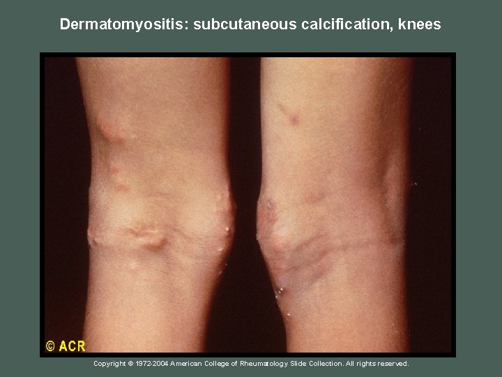 Dermatomyositis: subcutaneous calcification, knees Copyright © 1972 -2004 American College of Rheumatology Slide Collection.