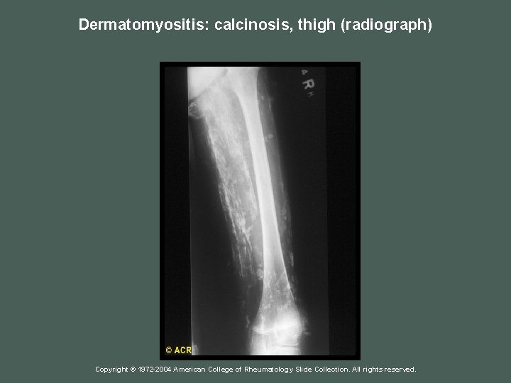Dermatomyositis: calcinosis, thigh (radiograph) Copyright © 1972 -2004 American College of Rheumatology Slide Collection.