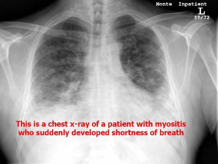 Copyright © 1972 -2004 American College of Rheumatology Slide Collection. All rights reserved. 