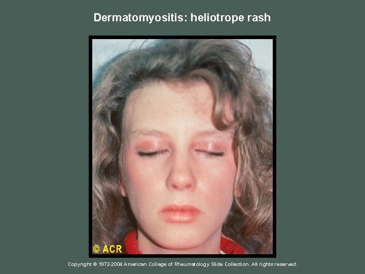 Dermatomyositis: heliotrope rash Copyright © 1972 -2004 American College of Rheumatology Slide Collection. All